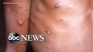 The symptoms treatment for monkeypox l ABC News [upl. by Ode]