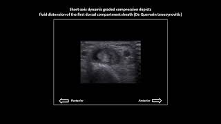 De Quervain tenosynovitis synovitis on wrist ultrasound [upl. by Anemolif]