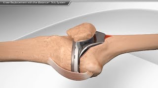 Knee Replacement with the iBalance TKA System [upl. by Eilsehc387]