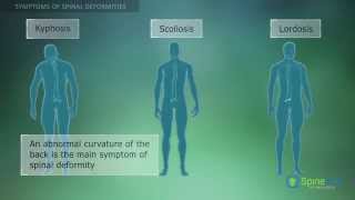 Spinal Deformities Symptoms [upl. by Annairt485]