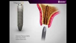 Implante Neodent  Titamax EX [upl. by Hamfurd]