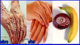 Onion anti wrinkle home remedies to remove wrinkles from hands in 5 days Get rid of wrinkles on hand [upl. by Acemat923]