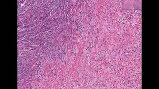 Histopathology OvaryTheca cell tumor [upl. by Eilla]