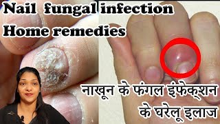 Paronychia treatment home remedies in hindi How to cure Nail fungus  Onychomycosis [upl. by Alinoel]