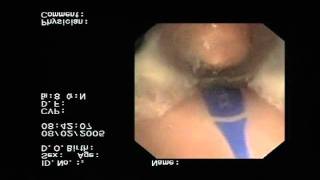 Epiglottic Blockage in Competitor Laryngeal Mask Airway [upl. by Ynamad490]