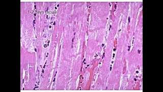 Evolution of a Myocardial Infarction [upl. by Viafore191]