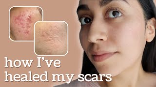 Healing Hyperpigmentation  Deep Pitted Acne Scars this is what I’ve done [upl. by Harpole238]