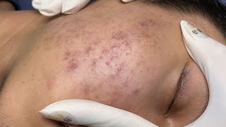 ACNE TREATMENT VU QUYNH MI  Blackheads On Boy Chin 2024FULL [upl. by Eram]