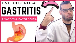 Anatomía Patológica  Enfermedad ulcerosa y gastritis [upl. by Enedan]