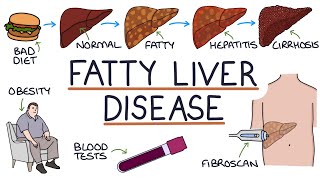 Understanding NonAlcoholic Fatty Liver Disease [upl. by Baggs684]