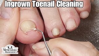 Ingrown Pincer Toenail Reversal [upl. by Iorio]