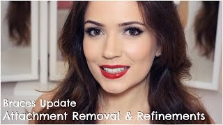 Invisalign  Attachments Removal amp Refinements [upl. by Violetta728]