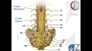 Degenerative Spine 9  Cauda EquinaConus Medullaris Syndromes [upl. by Esadnac965]