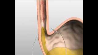 Endostim slokdarm kringspier stimulatie tegen zuurbranden [upl. by Ailadgim]