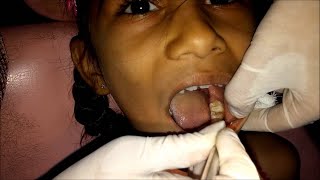 Extraction procedure of Lower Decidious Molars [upl. by Anieral]