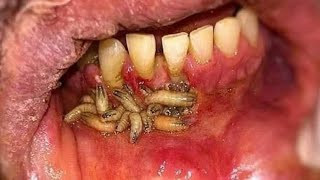 MYIASIS  Infection from flies  Management  Dr Zona khalid [upl. by Snyder582]