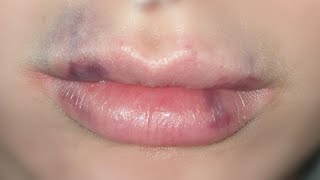 how to get rid of bruising after lip fillers tutorial [upl. by Verge]