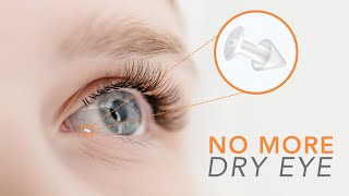 Say Goodbye to Dry Eyes with Punctal Plugs [upl. by Acinat]