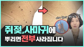 OO만 뿌리면 쥐젖 사마귀 똑 떨어진다고의사가 알려주는 쥐젖 사마귀 없애는 방법 [upl. by Nepets]