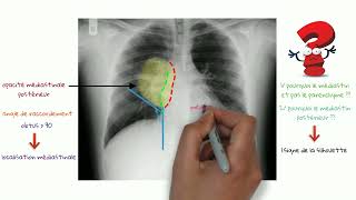 Comment Faire La Différence Entre Une Opacité Médiastinale Et Parenchymateuse 01 [upl. by Bernete]