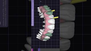 🦷💻👀 Colocação de gengiva em protocolo monolítico exocad dentista dental teeth cadcam dentist [upl. by Dlonyer767]