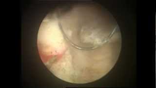 TURBT  TURP Cancer Prostate Surgery Video [upl. by Brod669]