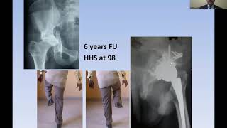 Dr Ramesh Sen THR in Acetabular Fractures [upl. by Narod265]