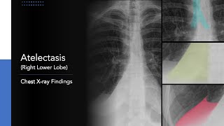 Atelectasis Right Lower Lobe Explanation of Chest Xray Findings [upl. by Lenoil992]