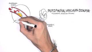 Cardiovascular Disease Overview [upl. by Mchail]