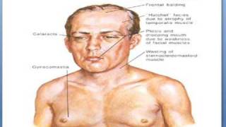 Myotonic dystrophy [upl. by Aloisius]