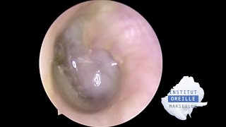 Perforated Purulent Otitis Media  Otite moyenne purulente perforée [upl. by Yaned]