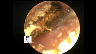 Cases of cholesteatoma treated by general anesthesia 20220709 [upl. by Gan329]