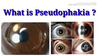 What is pseudophakia  sign  Intraocular lens  sharp vision [upl. by Dunning]