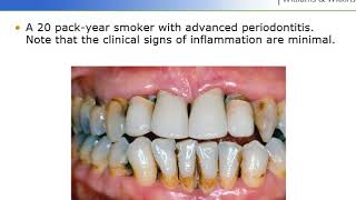 The Effects of Smoking on Periodontal Health  Perio Ch 11 Lect I [upl. by Theola559]