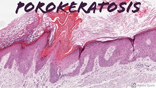 Porokeratosis 5Minute Pathology Pearls [upl. by Schoenburg669]