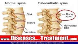 3 Osteophytes Bone Spur Causes Symptoms Diagnosis Treatment [upl. by Hillery]