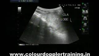 Doppler thyroid Retrosternal extension of thyroid [upl. by Dlanigger942]