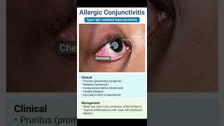 Allergic conjunctivitis [upl. by Coombs]