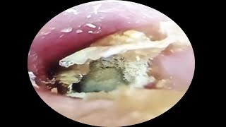 Fungous dry orange earwax extraction asmrearwax 20 [upl. by Ekaj616]