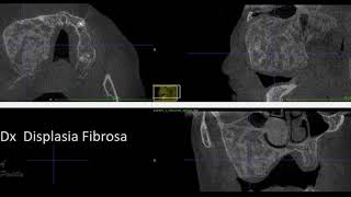 Displasia Fibrosa [upl. by Ilan]