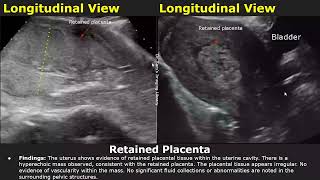 Postpartum Uterus Ultrasound Reporting  RPOCRetained Placenta Scan Reports  Pelvic USG [upl. by Warton]