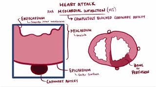 Heart attack acute myocardial infarction causes symptoms diagnosis treatment pathology [upl. by Bruis]