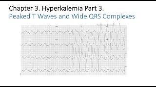 Hyperkalemia Part 3 Symptoms Diagnosis and Complications [upl. by Swart]