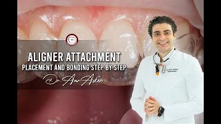 Aligner attachment placement and bonding step by step aligner delivery invisalign [upl. by Jada]