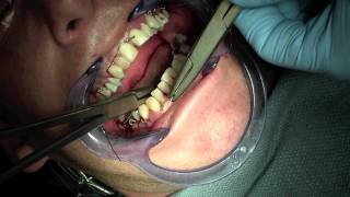 Jaw Fracture  Ivy Loop Placement Intraorally [upl. by Hermes]