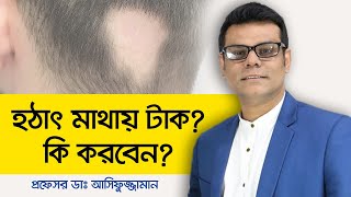 Alopecia Areata Treatment Bangla  Androgenetic Alopecia Treatment  হঠাৎ মাথায় টাক [upl. by Mehta530]