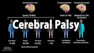 Cerebral Palsy Animation [upl. by Atnaloj]