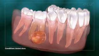 Dental Abcess  Why Root Canal Treatment Is Needed [upl. by Tudela]