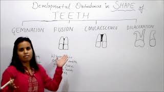 fusion Developmental tooth anomaly By Dr Prerna Shrivastava career Hub medical institute bhopal [upl. by Betthezul286]