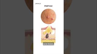 Acne Pimple Pus How to Get Rid of It  acne shorts [upl. by Fonz783]